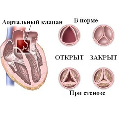 Stenoza aortică - tratament, simptome, cauze