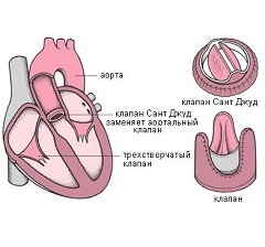 Stenoza aortică - tratament, simptome, cauze