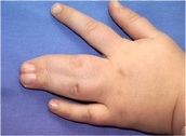 Deformarea articulațiilor degetelor, deformarea degetelor și patologia mâinilor