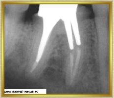 Revizia dentară, galerie foto, caz clinic nr. 5 realizând o ciocnire pliabilă și