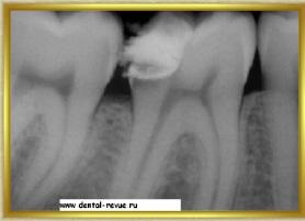 Revizia dentară, galerie foto, caz clinic nr. 5 realizând o ciocnire pliabilă și