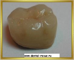 Revizia dentară, galerie foto, caz clinic nr. 5 realizând o ciocnire pliabilă și