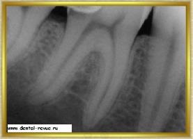Revizia dentară, galerie foto, caz clinic nr. 5 realizând o ciocnire pliabilă și