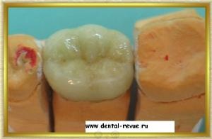 Revizia dentară, galerie foto, caz clinic nr. 5 realizând o ciocnire pliabilă și