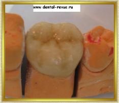 Revizia dentară, galerie foto, caz clinic nr. 5 realizând o ciocnire pliabilă și