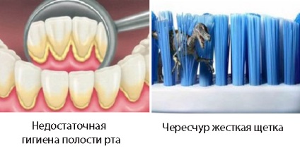 Az íny eltávolodott a fogtól - mi a teendő, ha a fogak az ínyen csupasz - fogászati ​​portál