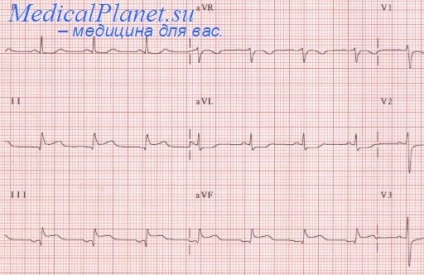 Diagnosticul infarctului ventriculului drept