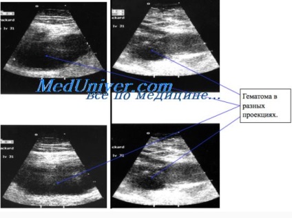 Дифузні зміни печінки на УЗД