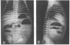 Obstrucție intestinală dinamică - cauze, simptome și tratament