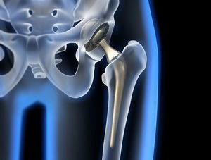 Endoproteticele articulației șoldului - tratamentul în Germania - tratamentul jurnalului în Germania