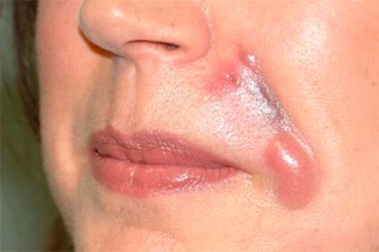 roșeața pliurilor nazolabiale provoacă miss coreea melc mucus riduri crema
