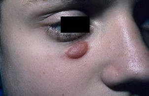 Granuloma simptome faciala, tratament, complicatii