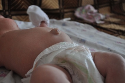 Újszülötteknél a herni az okai, tünetei és kezelése