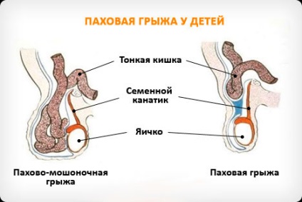 Hernia la nou-născuți provoacă, simptome și tratament