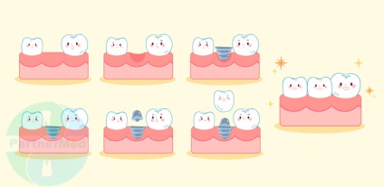 A fogak árának implantációja a perm fotóban, előnyökben és ellenjavallatokban