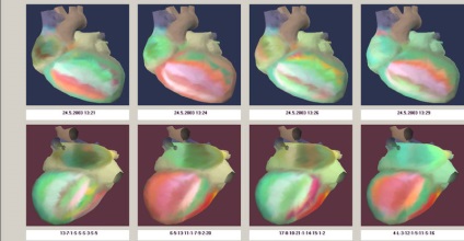 Myocardialis infarktus egészséges szívbetegek, cardiovisor