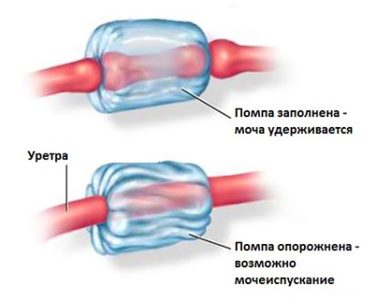 Mesterséges sphincter, az első mgmu urológiai klinikája