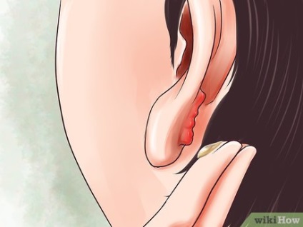 Cum să scapi rapid și ușor de o ruptură în lobul urechii