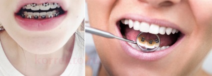Care este metoda corectă pentru a corecta mușcătura - chiar dinții pentru totdeauna