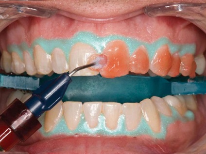 Cum sa albiti dintii pentru o zi, tratament dentar
