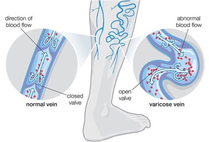 Как да стигнем до скриване на вените на краката 6 рецепти от разширени вени - нов ден