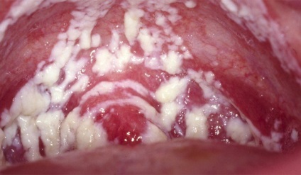 A nőknél a candidiasis és a candidiasis férfiak kezelésében