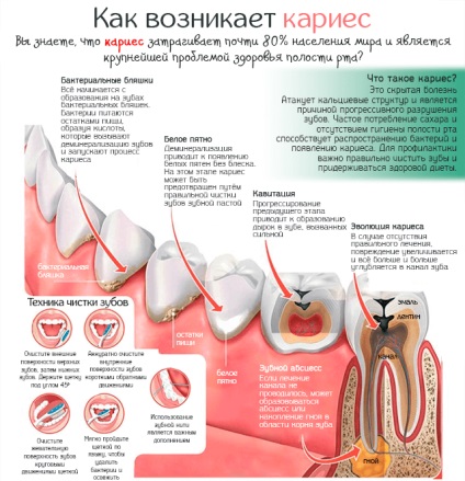 Caries - a fogszuvasodás és a szájhigiénia megelőzésének okai