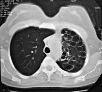 Hipoplazia pulmonară cistică - cauze, simptome, diagnostic și tratament