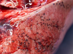 Sângerarea în cazul cauzelor cirozei hepatice și rezultatul apariției lor