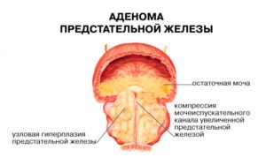 Tratamentul adenomului de prostată la domiciliu - metode și rețete