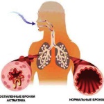 A bronchiális asztma természetes gyógymódokkal való kezelése