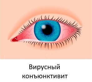 Tratamentul keratoconjunctivitei oculare și a cauzelor acesteia