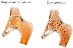 Tratamentul osteoporozei la femei - specificitatea procesului, metode de prevenire