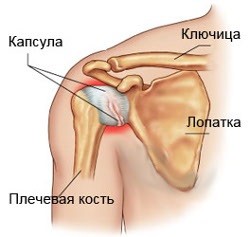 Лечение на замразено рамо, periarthrosis