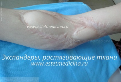 Tratamentul cicatricilor după arsuri și leziuni din plastic, fotografii înainte și după, revista online