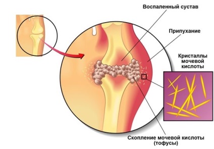 Tratamentul inflamației articulațiilor degetelor