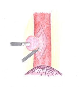 Leiomyomul esofagului ceea ce este, tratamentul și simptomele