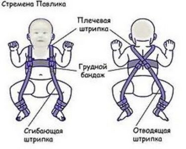 Lfk cu displazie articulațiilor șoldului la copii - când este aplicată, intensitatea exercițiilor și a acestora
