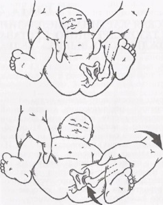 Lfk cu displazie articulațiilor șoldului la copii - când este aplicată, intensitatea exercițiilor și a acestora