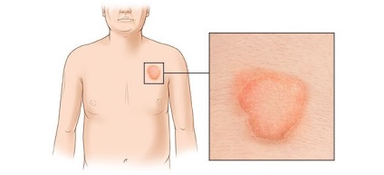 Ringworm pe tratamentul și prevenirea corpului