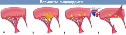 A fertőző endocarditis fejlődésének mechanizmusai (patogenezis)