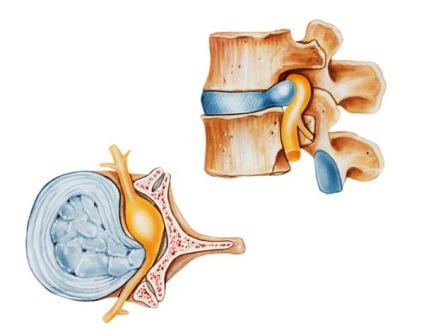 Mielopatia simptomelor regiunii cervicale la nivelul toracic sau coloanei vertebrale, tratament