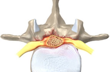 A nyaki régió myelopathiája tünetei a mellkasi vagy gerinc szintjén, kezelés