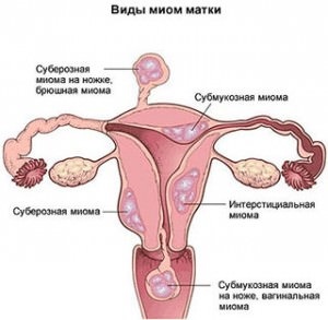 Myomii uterului - cauze, simptome, tratament