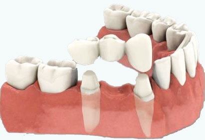 Poduri pentru și contra - prodental - în dolgoprudnoe și lobi