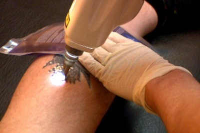 Tetoválhatok a mécsesekről, és mi veszélyes