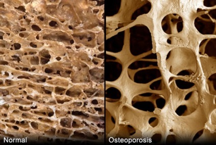 Osteoporoza - cauze, semne, simptome și tratament