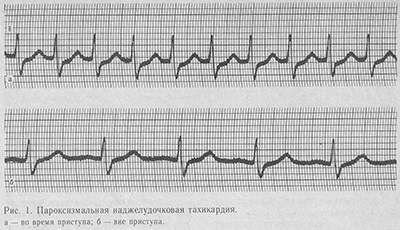 Efectul tahicardiei paroxistice - tratamentul inimii