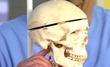 Fractura de baza a craniului - consecintele traumei