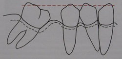 Întrebări frecvente privind combinarea tratamentului ortodontic și implantarea dinților